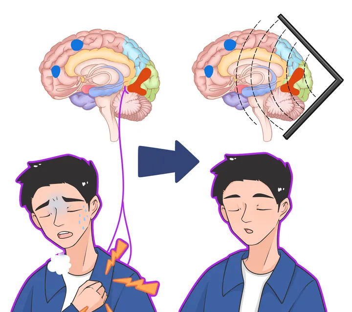 腦卒中對比示意